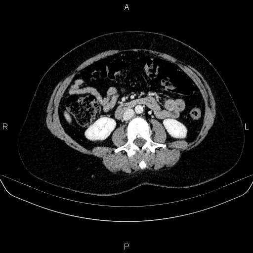 Adrenal cortical carcinoma (Radiopaedia 84882-100379 Axial C+ portal venous phase 46).jpg