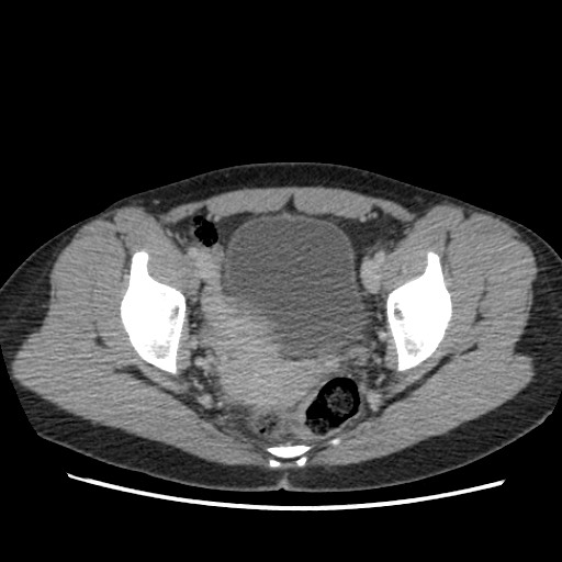 Adrenal cyst (Radiopaedia 64869-73813 Axial C+ portal venous phase 71).jpg