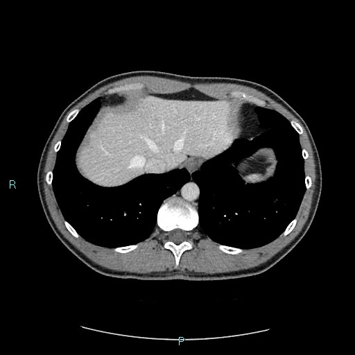 Adrenal cystic lymphangioma (Radiopaedia 83161-97534 Axial C+ portal venous phase 14).jpg
