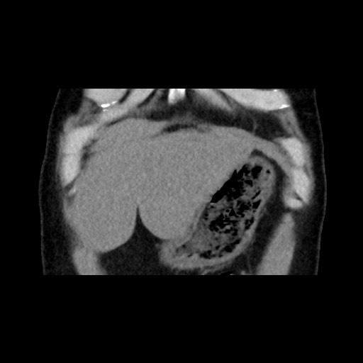 Adrenal gland trauma (Radiopaedia 81351-95079 Coronal non-contrast 17).jpg