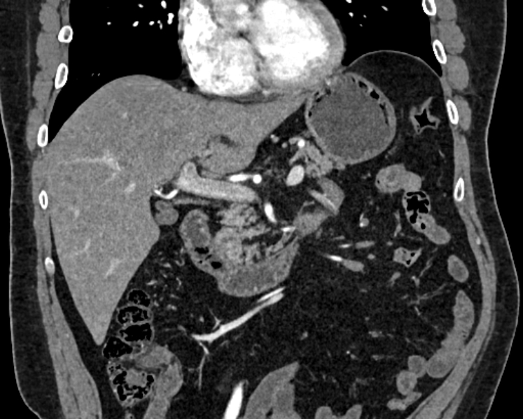 Adrenal metastases (Radiopaedia 73082-83791 Coronal C+ arterial phase 7).jpg