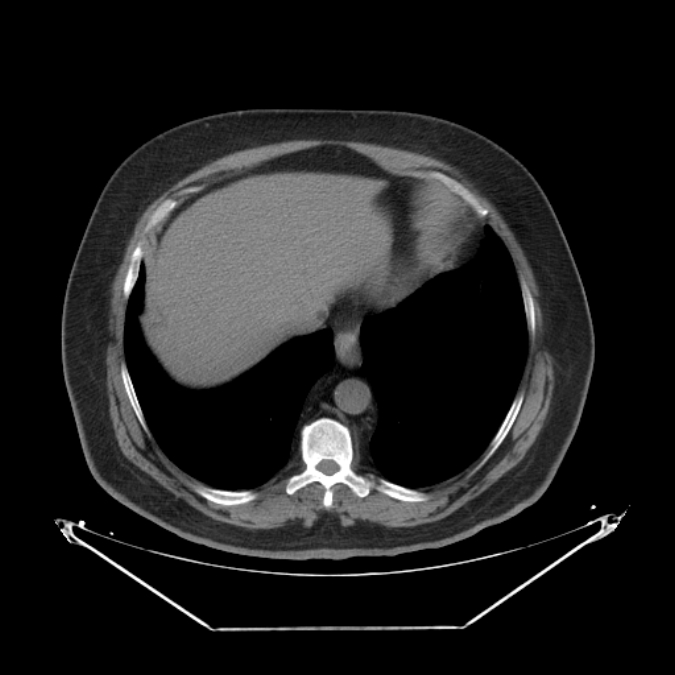 Adrenal myelolipoma (Radiopaedia 26278-26407 Axial non-contrast 4).jpg