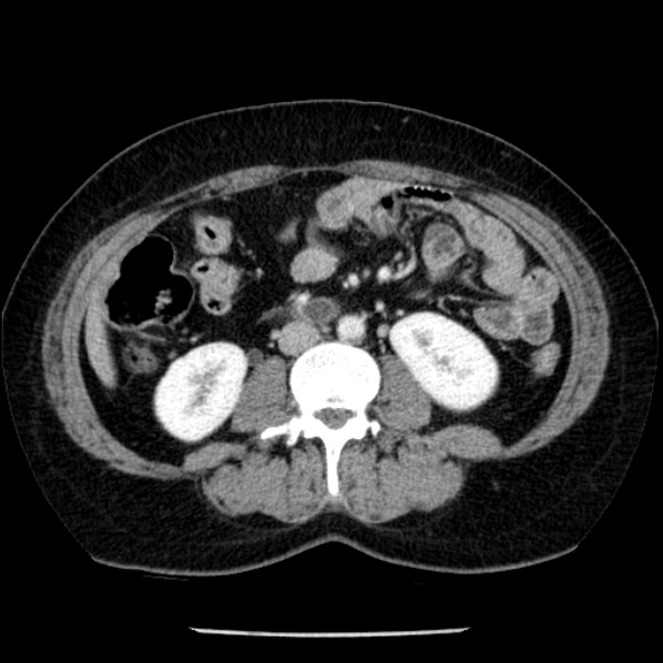 Adrenal myelolipoma (Radiopaedia 43401-46759 Axial C+ portal venous phase 45).jpg