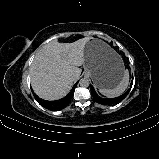 Adrenal myelolipoma (Radiopaedia 82742-96986 Axial non-contrast 23).jpg