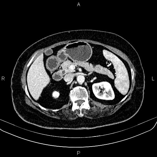 Adrenal myelolipoma (Radiopaedia 82742-96986 Axial renal cortical phase 62).jpg
