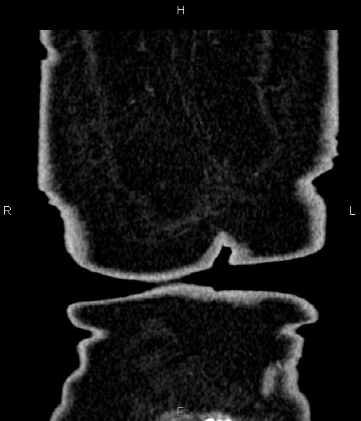 Adrenal myelolipoma (Radiopaedia 82742-96986 Coronal renal cortical phase 77).jpg