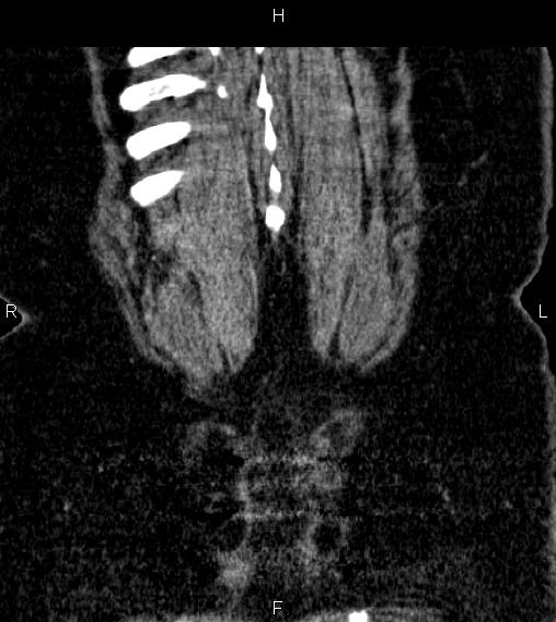 Adrenal myelolipoma (Radiopaedia 84319-99617 Coronal renal cortical phase 76).jpg