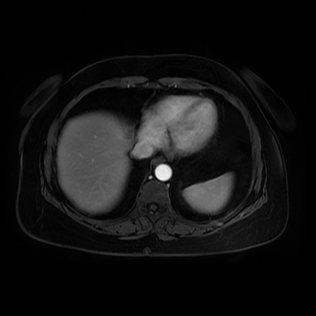 Adrenal myelolipoma - MRI (Radiopaedia 83249-97646 T1 fat sat arterial phase 3).jpg