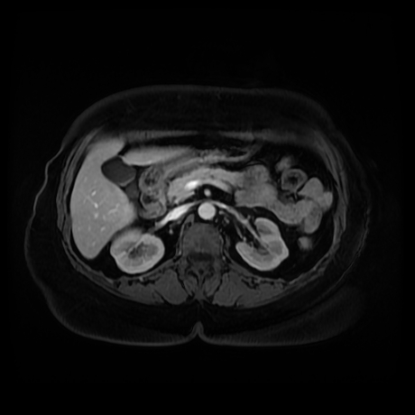 Adrenal myelolipoma - MRI (Radiopaedia 83249-97646 T1 fat sat arterial phase 40).jpg