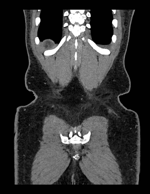 Adrenal myelolipoma - bilateral (Radiopaedia 74805-85810 Coronal C+ portal venous phase 61).jpg