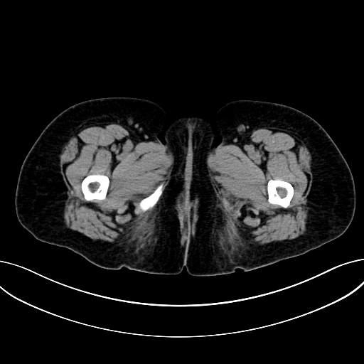 Adrenocortical carcinoma (Radiopaedia 87281-103569 Axial non-contrast 96).jpg