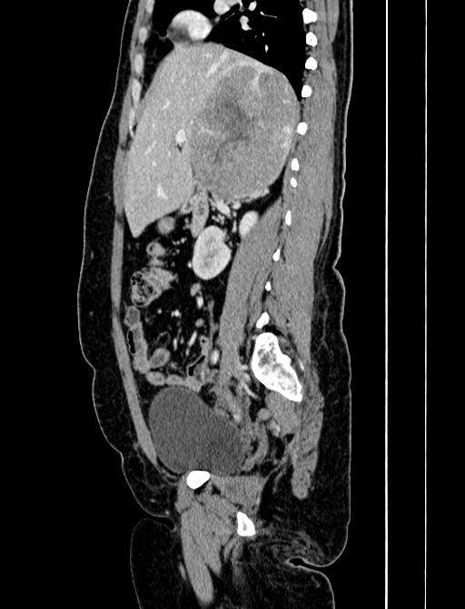 Adrenocortical carcinoma (Radiopaedia 87281-103569 Sagittal C+ portal venous phase 106).jpg