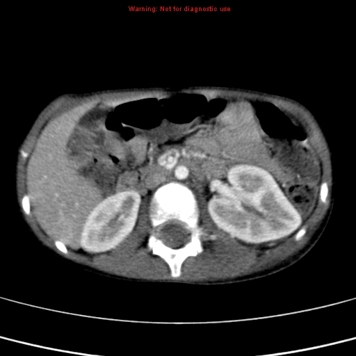 File:Adrenocortical carcinoma (Radiopaedia 9449-10131 Axial C+ portal venous phase 25).jpg