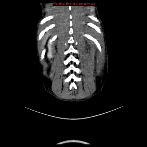 File:Adrenocortical carcinoma (Radiopaedia 9449-10131 Coronal C+ portal venous phase 20).jpg