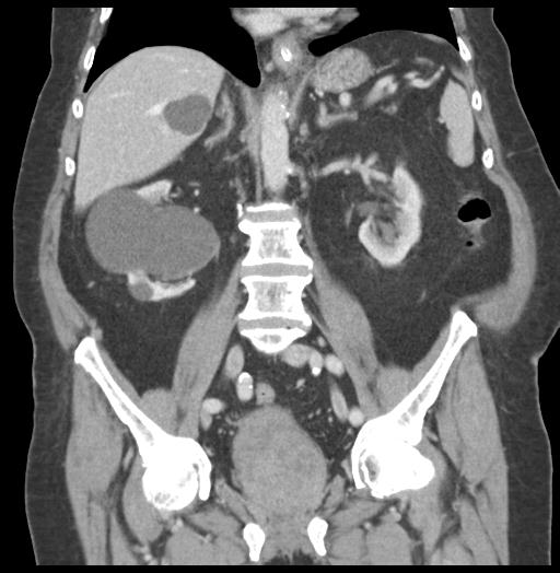 Adult ileal intussusception with secondary obstruction (Radiopaedia 30395-31051 Coronal C+ portal venous phase 36).jpg