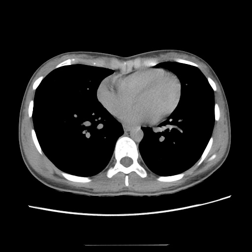 Adult polycystic kidney disease (Radiopaedia 48845-53876 Axial renal excretory phase 2).jpg