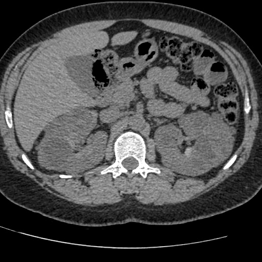 Adult polycystic kidney disease (Radiopaedia 59075-66368 Axial non-contrast 23).jpg