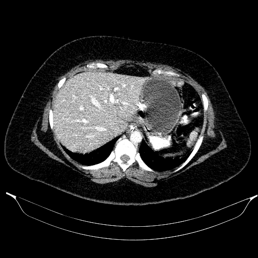 File:Afferent loop syndrome - secondary to incarcerated trocar site hernia (Radiopaedia 82959-97305 Axial C+ portal venous phase 43).jpg