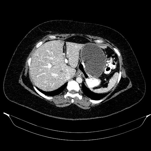 File:Afferent loop syndrome - secondary to incarcerated trocar site hernia (Radiopaedia 82959-97305 Axial C+ portal venous phase 49).jpg