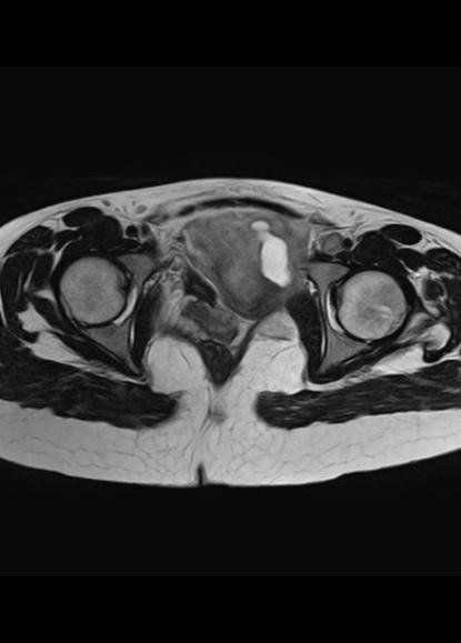 File:Aggressive angiomyxoma of the pelvis and perineum (Radiopaedia 59162-66479 Axial T2 7).jpg