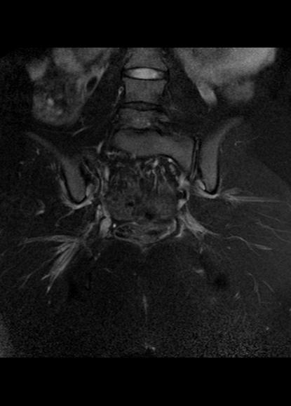 File:Aggressive angiomyxoma of the pelvis and perineum (Radiopaedia 59162-66479 Coronal T2 fat sat 21).jpg