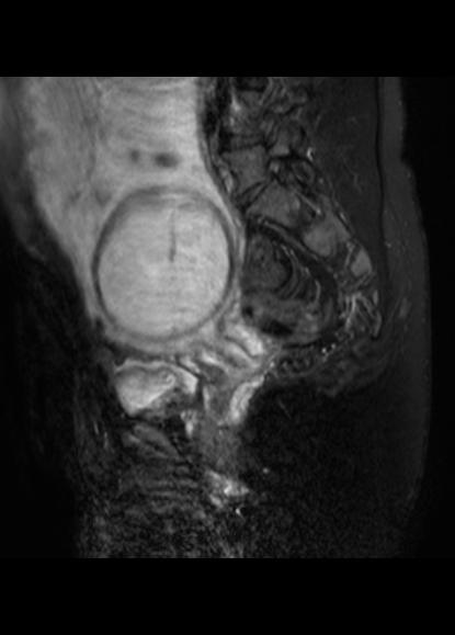 File:Aggressive angiomyxoma of the pelvis and perineum (Radiopaedia 59162-66479 Sagittal T2 fat sat 16).jpg