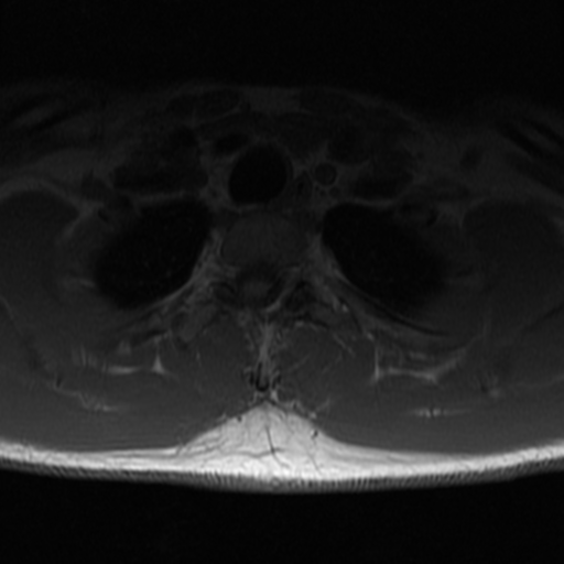 File:Aggressive vertebral hemangioma (Radiopaedia 39937-42404 Axial T1 37).png