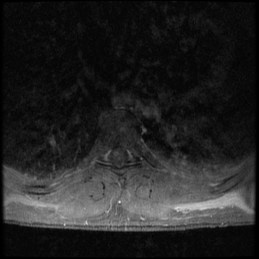 File:Aggressive vertebral hemangioma (Radiopaedia 39937-42404 Axial T1 C+ fat sat 18).png