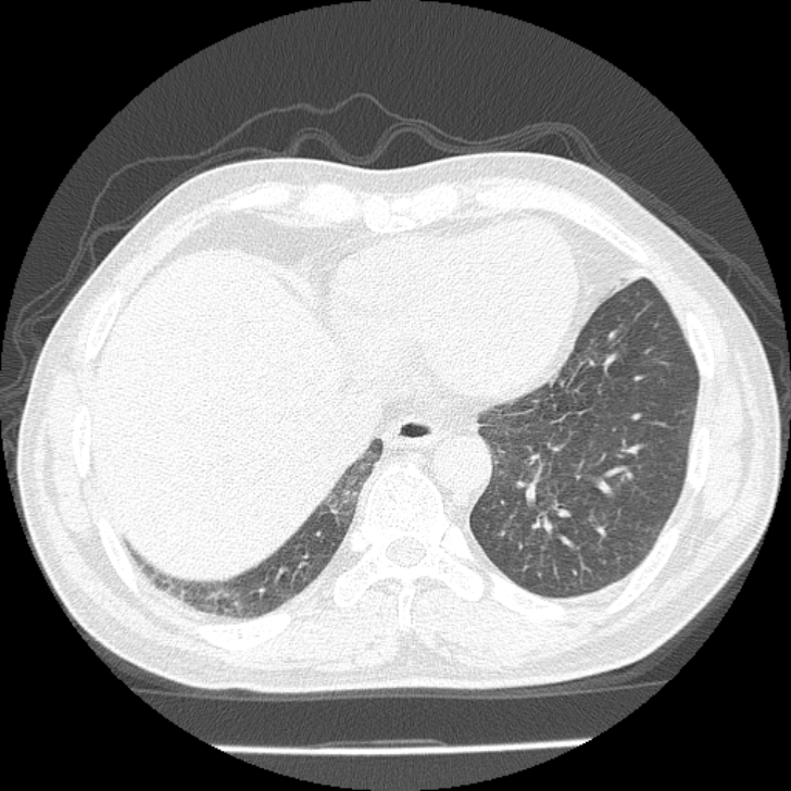 Airway foreign body in adult (Radiopaedia 85907-101779 Axial lung window 147).jpg