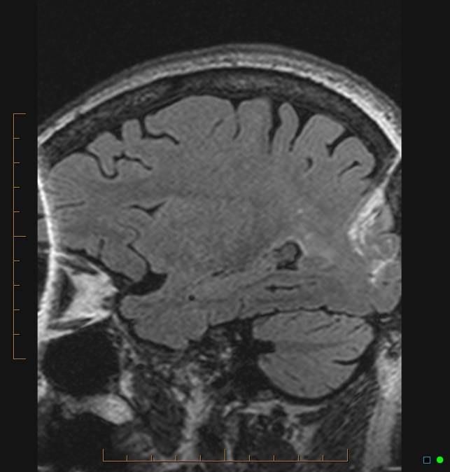 Aliasing artifact causing a spurious cerebellar lesion (Radiopaedia 48783-53810 Sagittal FLAIR 93).jpg