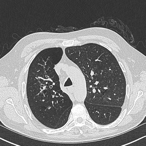File:Allergic bronchopulmonary aspergillosis (Radiopaedia 44760-48571 Axial lung window 21).png