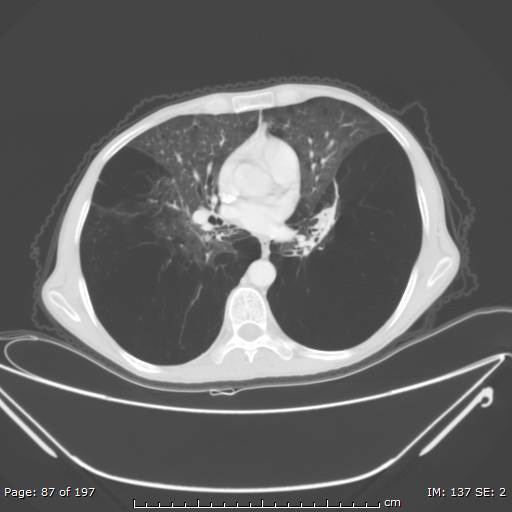 Alpha-1-antitrypsin deficiency (Radiopaedia 50561-55987 Axial lung window 37).jpg