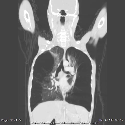 Alpha-1-antitrypsin deficiency (Radiopaedia 50561-55987 Coronal lung window 34).jpg