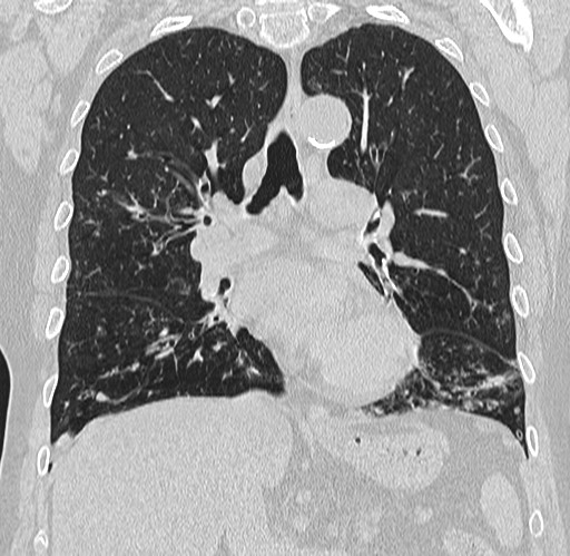 Alpha-1-antitrypsin deficiency (Radiopaedia 72058-82557 Coronal lung window 42).jpg
