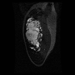 Alveolar soft part sarcoma (Radiopaedia 64501-73678 D 114).jpg