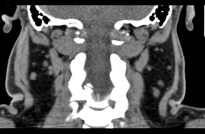 Ameloblastoma (Radiopaedia 33677-34806 Coronal non-contrast 52).png