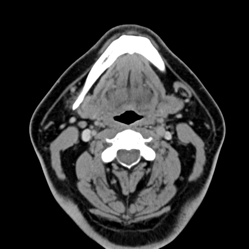 Ameloblastoma (Radiopaedia 38520-40623 Axial non-contrast 37).png