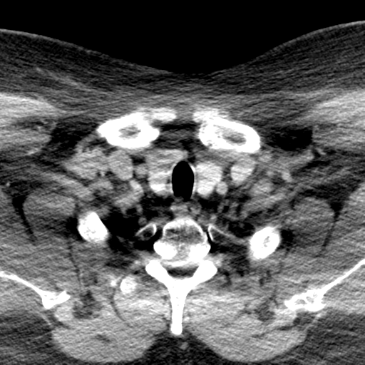 Ameloblastoma (Radiopaedia 38520-40623 Axial non-contrast 72).png