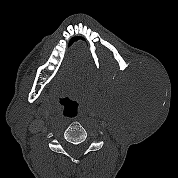 Ameloblastoma (Radiopaedia 51921-57766 Axial bone window 62).jpg