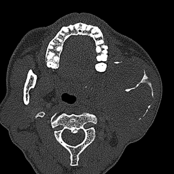 Ameloblastoma (Radiopaedia 51921-57766 Axial bone window 94).jpg