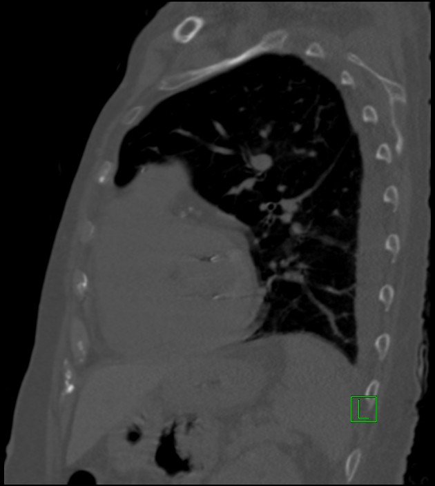 Amiodarone deposition in the liver (Radiopaedia 77587-89780 Sagittal bone window 33).jpg