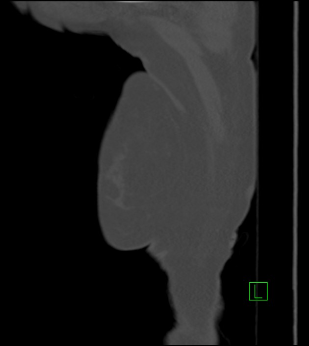 Amiodarone deposition in the liver (Radiopaedia 77587-89780 Sagittal bone window 99).jpg
