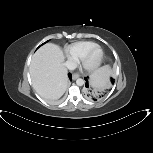 File:Amoebic liver abscess (Radiopaedia 52611-58530 A 12).png