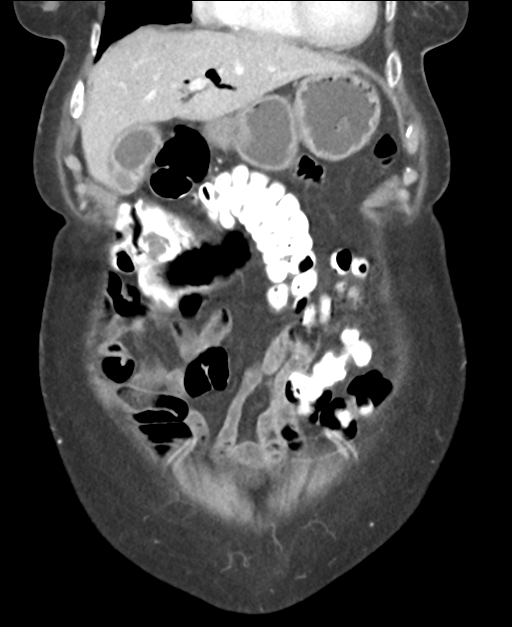Ampullary adenocarcinoma (Radiopaedia 34013-35237 E 15).png