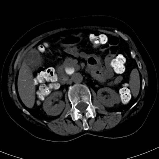 File:Ampullary adenocarcinoma (Radiopaedia 34013-35241 AXIAL THICK 38).png