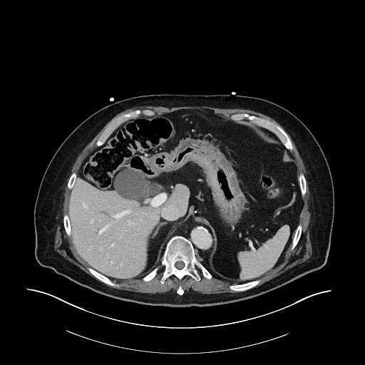Ampullary adenocarcinoma (Radiopaedia 59373-66734 C 41).jpg