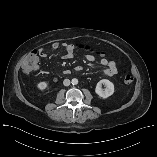 Ampullary adenocarcinoma (Radiopaedia 59373-66737 A 88).jpg