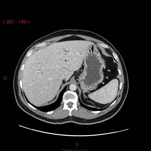 Ampullary carcinoma (Radiopaedia 56396-63056 C 21).jpg