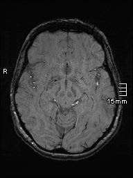 Amyotrophic lateral sclerosis (Radiopaedia 70821-81017 Axial SWI 21).jpg