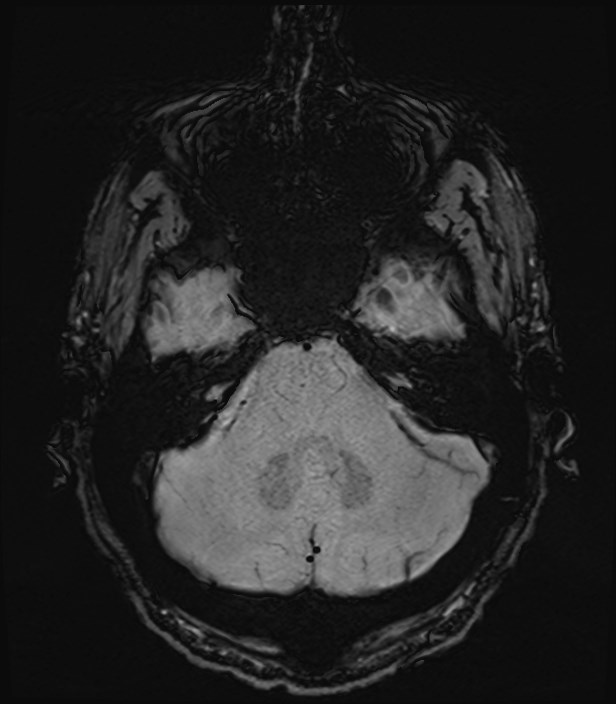 Amyotrophic lateral sclerosis (Radiopaedia 87352-103658 Axial SWI 8).jpg